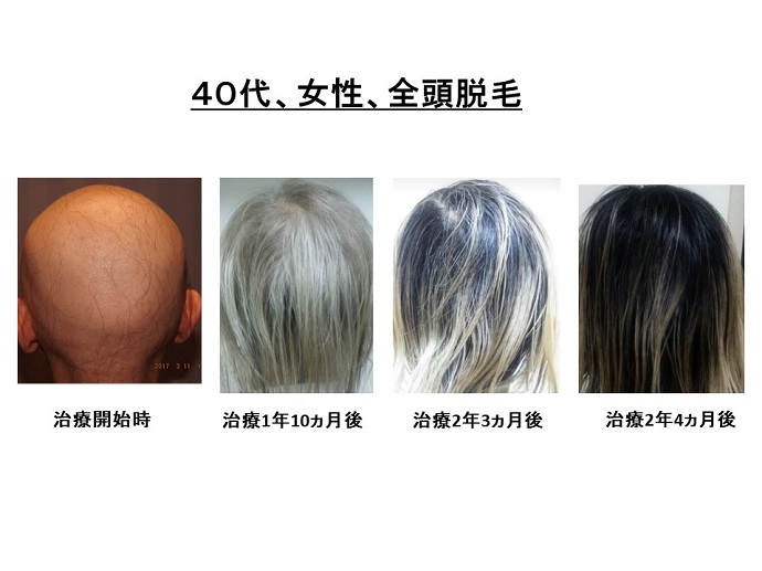 円形脱毛症　病院